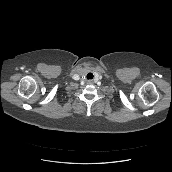 File:Aberrant right subclavian and left vertebral arteries (Radiopaedia 43467-46847 Axial C+ portal venous phase 1).jpg