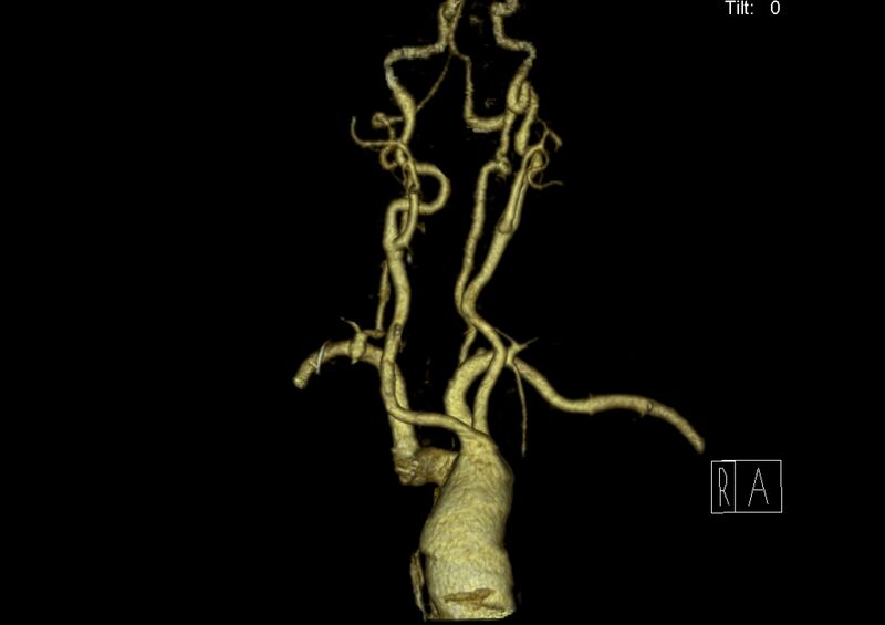File:Aberrant right subclavian artery (Radiopaedia 19283-19294 3D reconstruction C+ arterial phase 4).jpg