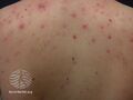 Acne affecting the back images (DermNet NZ acne-acne-back-159).jpg