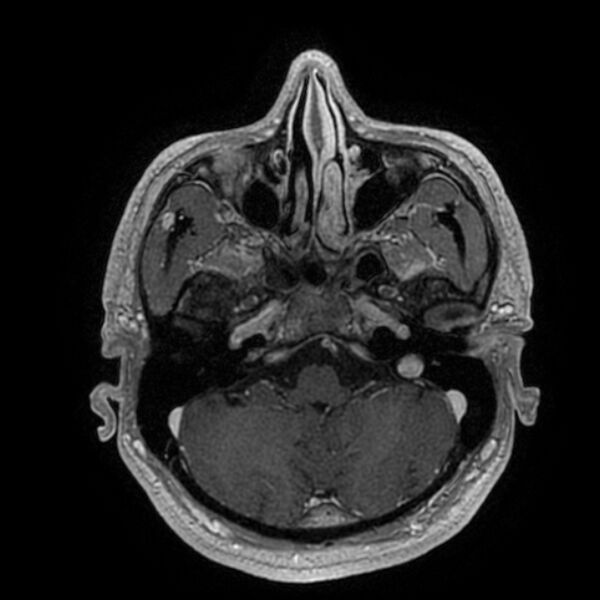 File:Acoustic schwannoma - intracanalicular (Radiopaedia 37247-39024 Axial T1 C+ 58).jpg