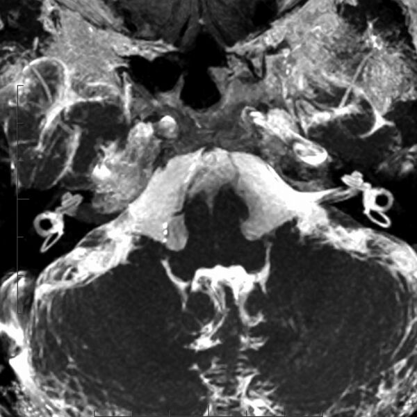 File:Acoustic schwannoma - intracanalicular (Radiopaedia 9937-10504 Axial T2 MIP 1).jpg