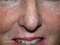 Actinic Keratoses treated with imiquimod (DermNet NZ lesions-ak-imiquimod-3753).jpg