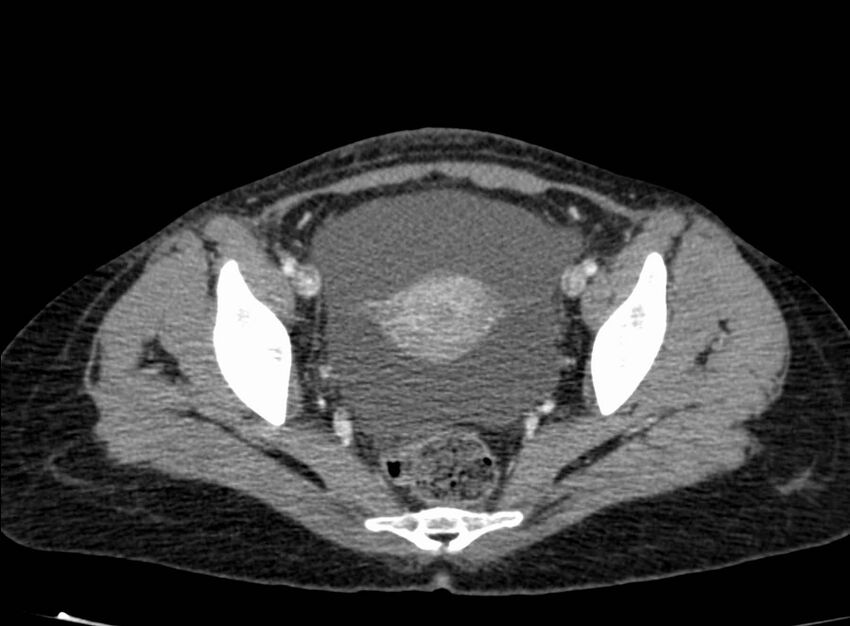 Acute Budd-Chiari syndrome (Radiopaedia 60858-68638 Axial C+ portal venous phase 263).jpg