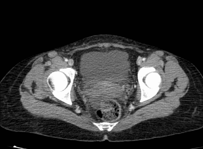 Acute Budd-Chiari syndrome (Radiopaedia 60858-68638 Axial C+ portal venous phase 277).jpg