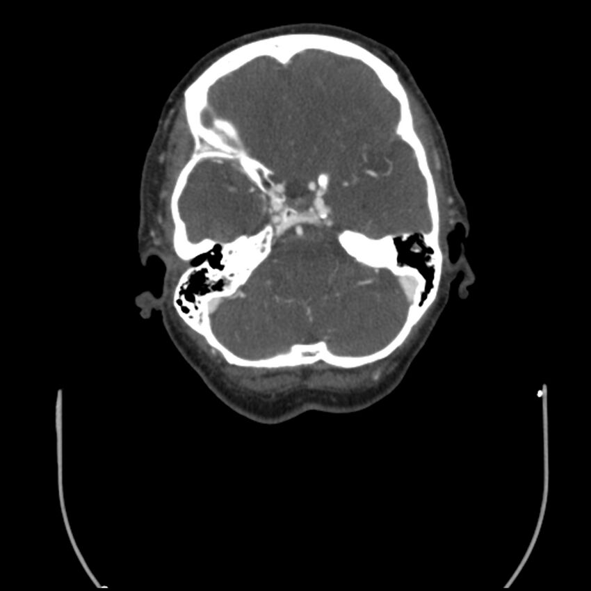 Acute M1 occlusion with ischemic penumbra (CT perfusion) (Radiopaedia 71897-82344 Axial C+ arterial phase thins 110).jpg