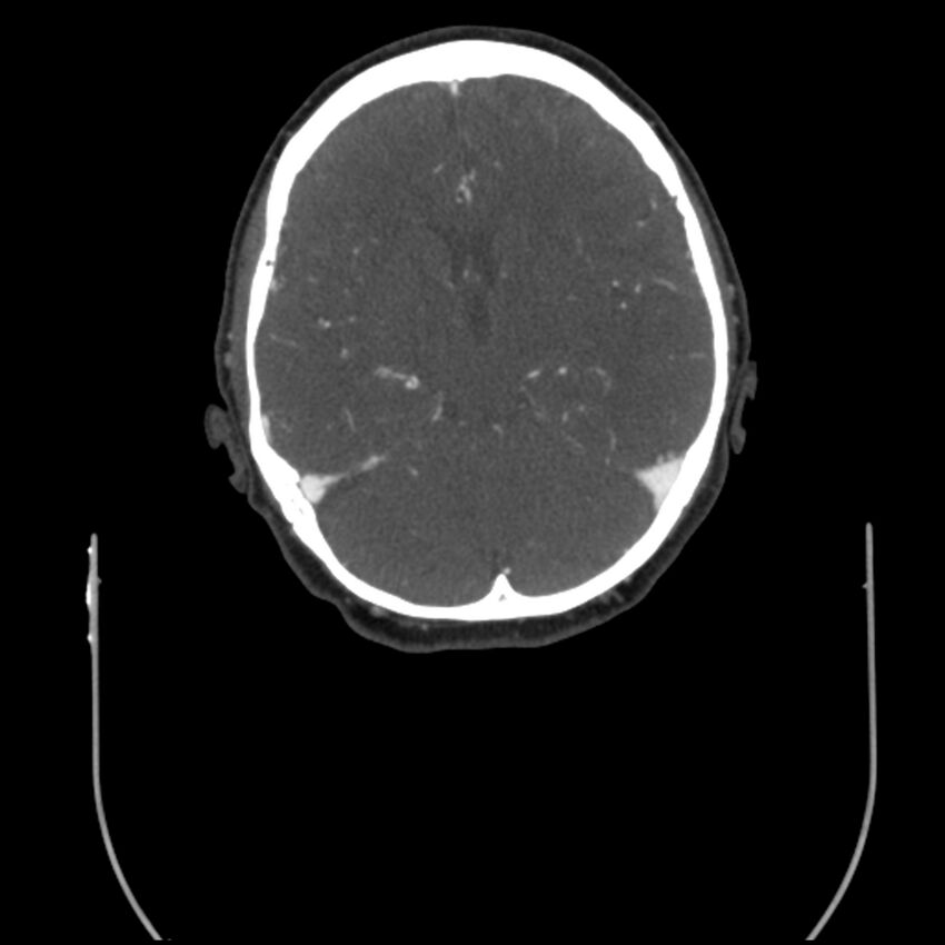 Acute M1 occlusion with ischemic penumbra (CT perfusion) (Radiopaedia 71897-82344 Axial C+ arterial phase thins 65).jpg