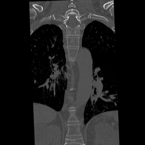 File:Acute and chronic vertebral compression fractures (Radiopaedia 31608-32494 Coronal bone window 16).jpg