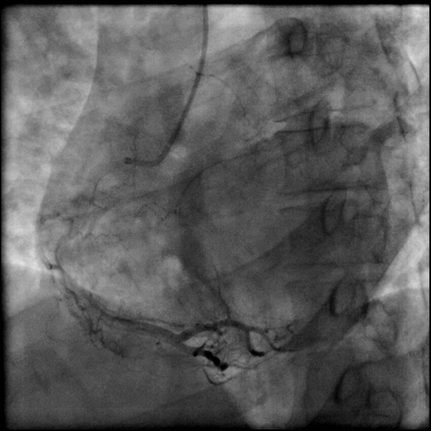 Acute anteroseptal myocardial infarction (Radiopaedia 68409-77946 RAO straight RCA 58).jpg