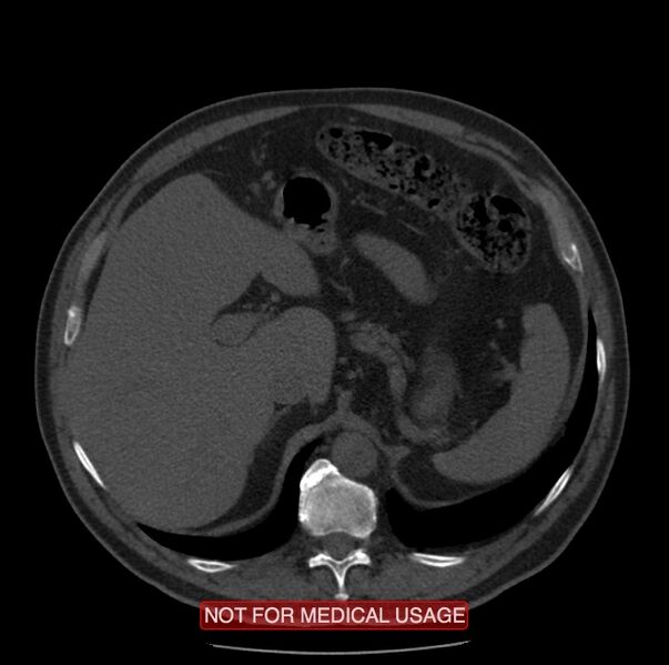File:Acute aortic dissection - Stanford type A (Radiopaedia 40661-43285 Axial non-contrast 77).jpg