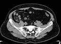 Acute appendicitis (Radiopaedia 13030-13091 Axial non-contrast 37).jpg