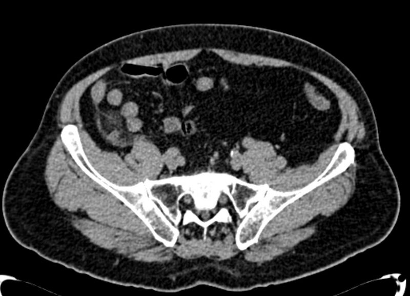 File:Acute appendicitis (Radiopaedia 13030-13091 Axial non-contrast 37).jpg