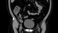 Acute appendicitis (Radiopaedia 13030-13091 Coronal non-contrast 6).jpg