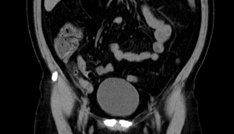 File:Acute appendicitis (Radiopaedia 13030-13091 Coronal non-contrast 6).jpg