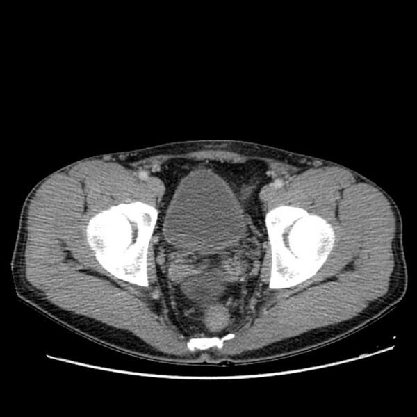 File:Acute appendicitis (Radiopaedia 27049-27227 Axial C+ portal venous phase 70).jpg