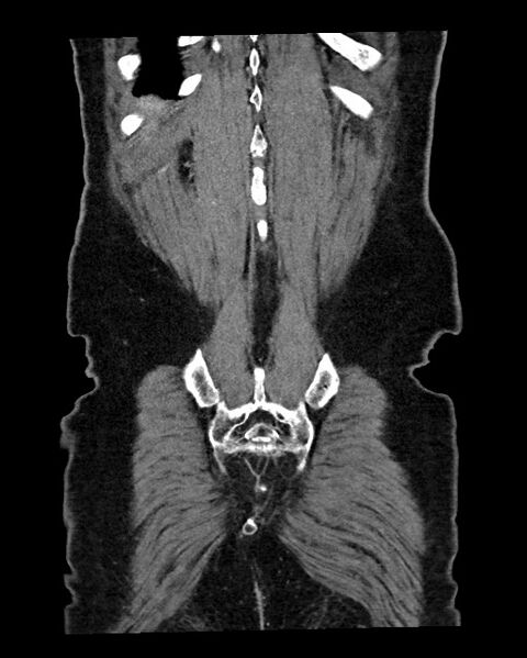 File:Acute appendicitis - large appendicoliths (Radiopaedia 61805-69820 Coronal C+ portal venous phase 120).jpg