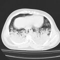 Acute aspiration pneumonitis (Radiopaedia 33605-34703 Axial lung window 69).jpg
