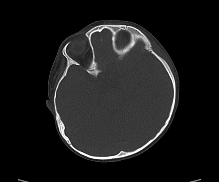 Acute hemorrhagic contusion (Radiopaedia 63660-72336 Axial bone window 25).jpg