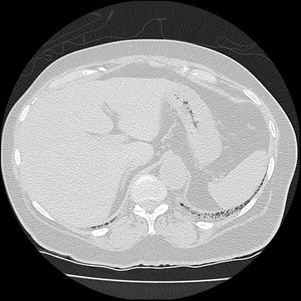File:Acute interstitial pneumonitis (Radiopaedia 45404-49452 Axial lung window 87).jpg