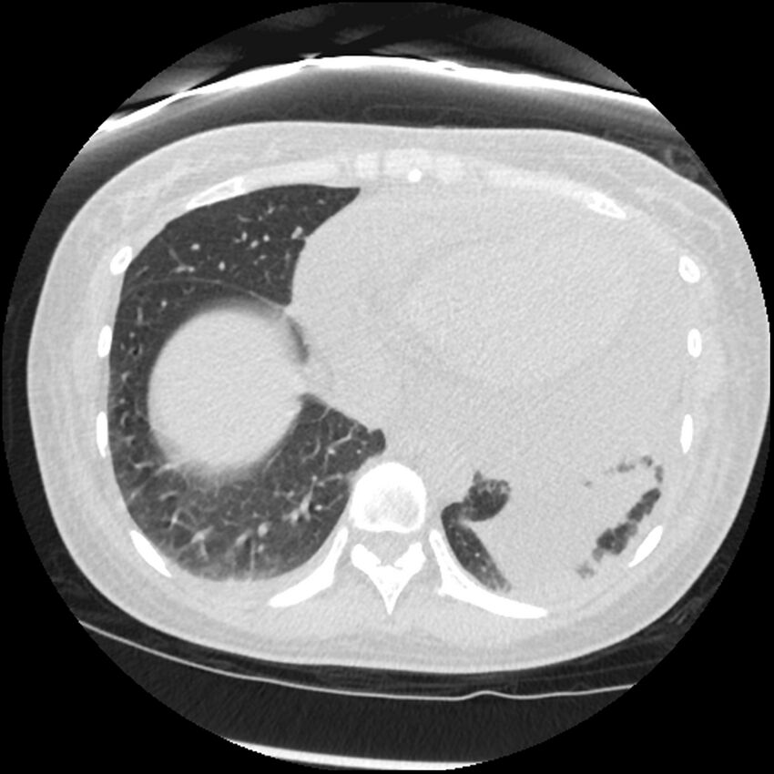 Acute lupus nephritis (Radiopaedia 45832-50107 Axial lung window 74).jpg