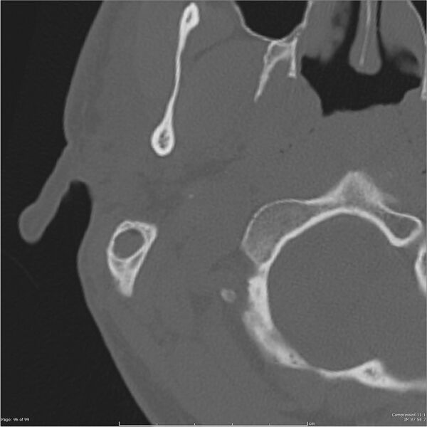 File:Acute otomastoiditis (Radiopaedia 28276-28512 Axial PTB bone window reformat 76).jpg
