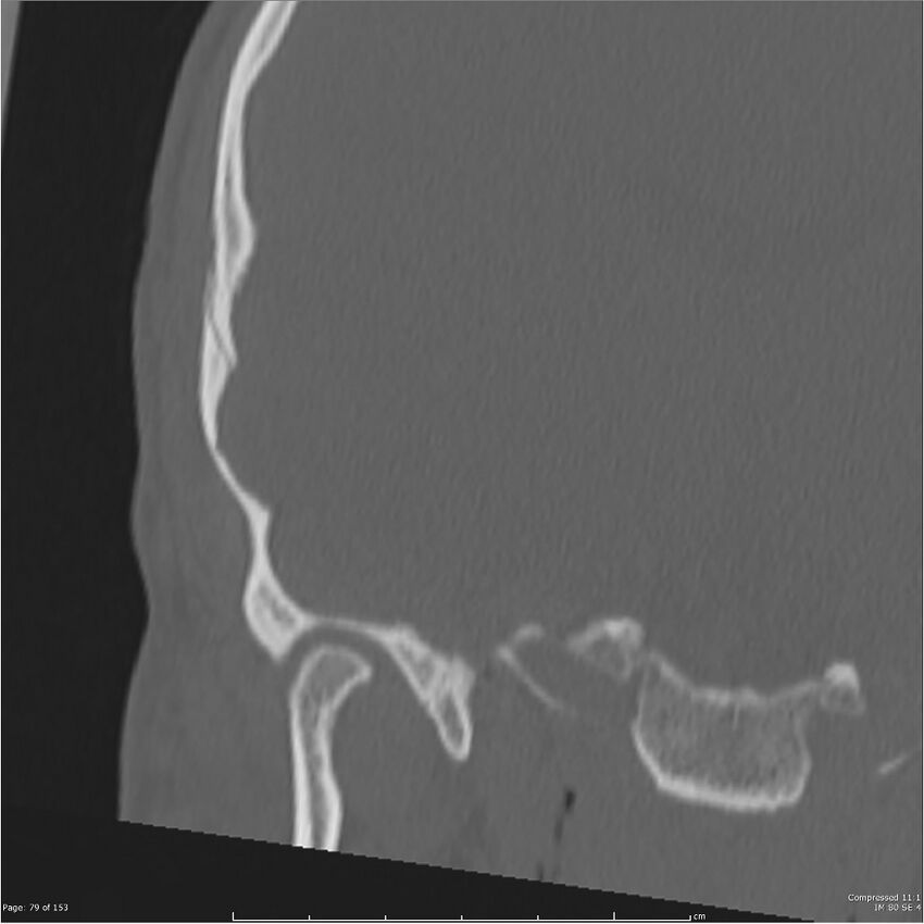 Acute otomastoiditis (Radiopaedia 28276-28512 Coronal PTB bone window reformat 10).jpg