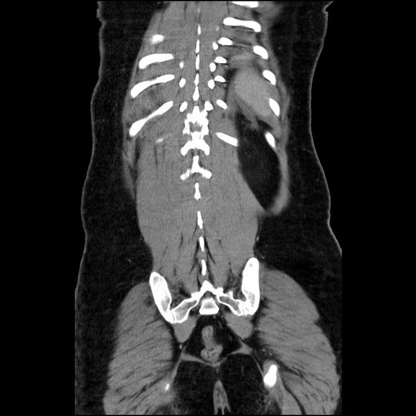 File:Acute pancreatitis (Radiopaedia 69236-79012 Coronal C+ portal venous phase 21).jpg