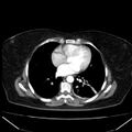 Acute pancreatitis - Balthazar C (Radiopaedia 26569-26714 Axial C+ arterial phase 1).jpg