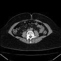 Acute pancreatitis - Balthazar C (Radiopaedia 26569-26714 Axial non-contrast 57).jpg