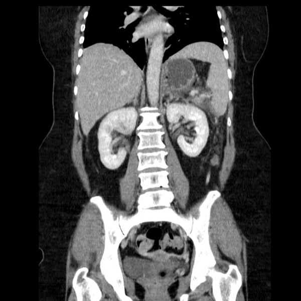 File:Acute pancreatitis - Balthazar C (Radiopaedia 26569-26714 Coronal C+ portal venous phase 43).jpg