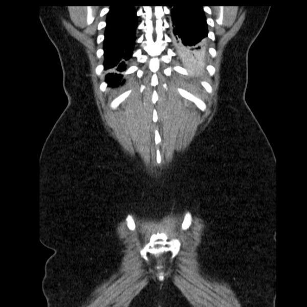 File:Acute pancreatitis - Balthazar C (Radiopaedia 26569-26714 Coronal C+ portal venous phase 60).jpg