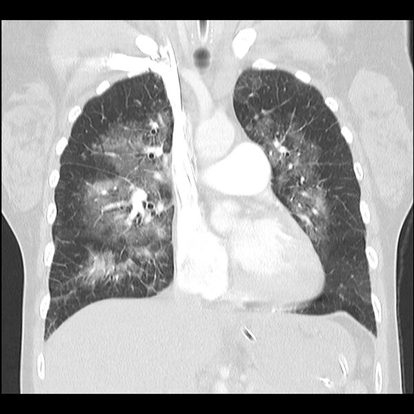 File:Acute pulmonary edema on CT (Radiopaedia 33582-34672 Coronal lung window 15).jpg