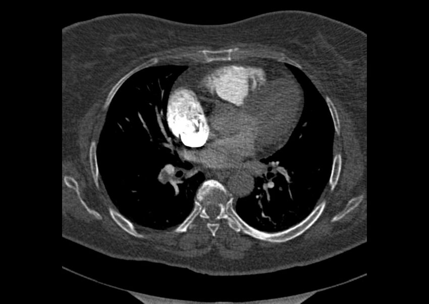 Acute pulmonary embolism (Radiopaedia 29938-30466 Axial C+ CTPA 108).jpg