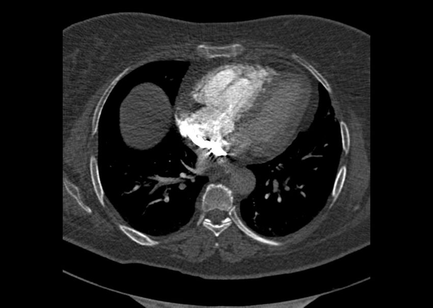 Acute pulmonary embolism (Radiopaedia 29938-30466 Axial C+ CTPA 141).jpg