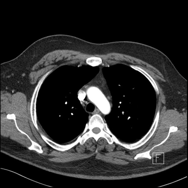 File:Acute pulmonary embolism with pulmonary infarct (Radiopaedia 73062-83768 Axial C+ CTPA 20).jpg