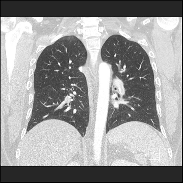 File:Acute pulmonary embolism with pulmonary infarct (Radiopaedia 73062-83768 Coronal lung window 48).jpg