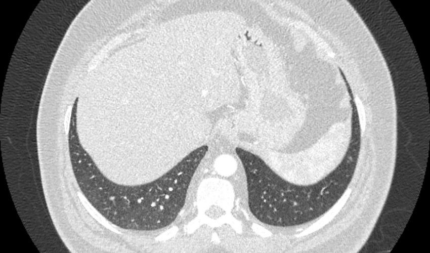 Acute pulmonary embolism with pulmonary infarcts (Radiopaedia 77688-89908 Axial lung window 115).jpg