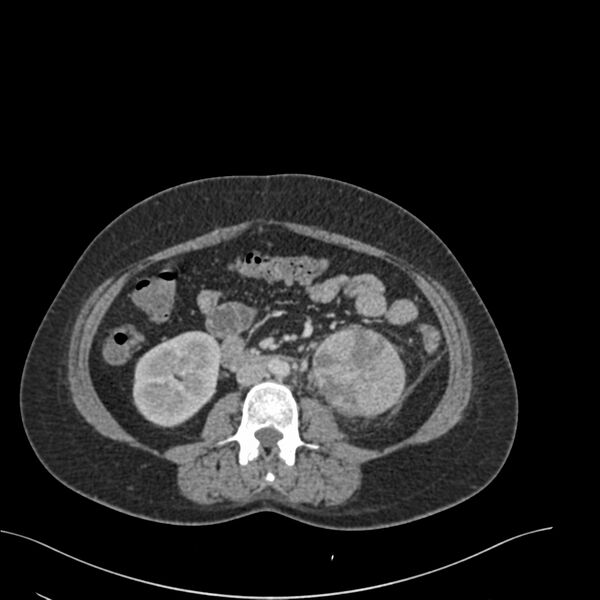 File:Acute pyelonephritis with renal vein thrombosis (Radiopaedia 58020-65053 Axial renal parenchymal phase 100).jpg