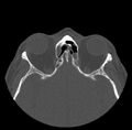 Acute sinusitis (Radiopaedia 23161-23215 Axial bone window 54).jpg
