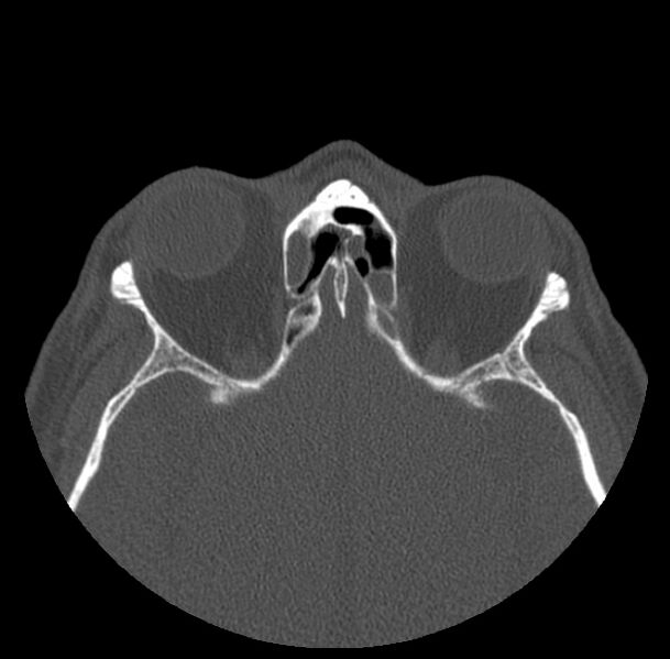 File:Acute sinusitis (Radiopaedia 23161-23215 Axial bone window 54).jpg