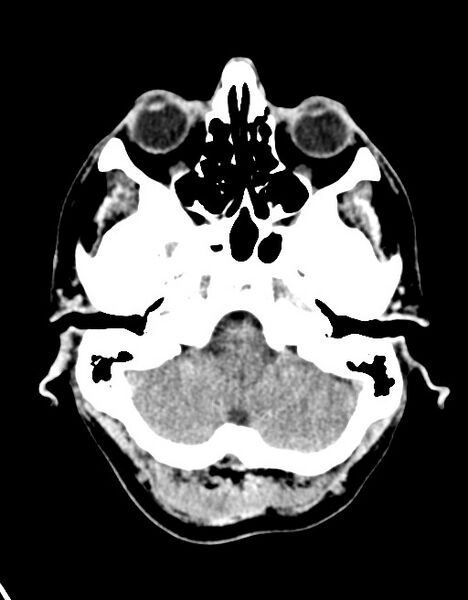 File:Acute superior cerebellar artery territory infarct (Radiopaedia 84104-99359 Axial non-contrast 55).jpg