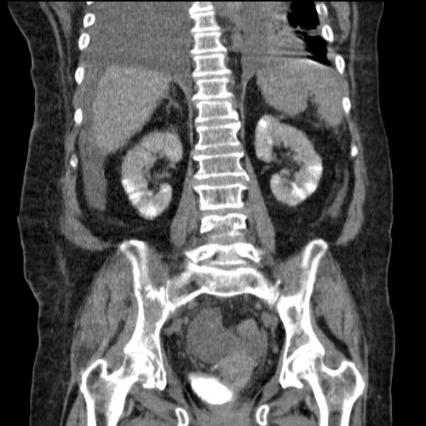 File:Acute tubular necrosis (Radiopaedia 28077-28334 D 57).jpg