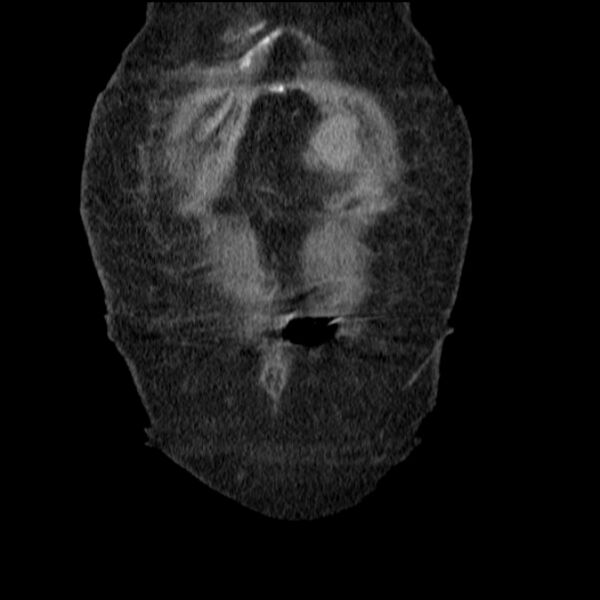 File:Acute tubular necrosis (Radiopaedia 28077-28334 G 12).jpg