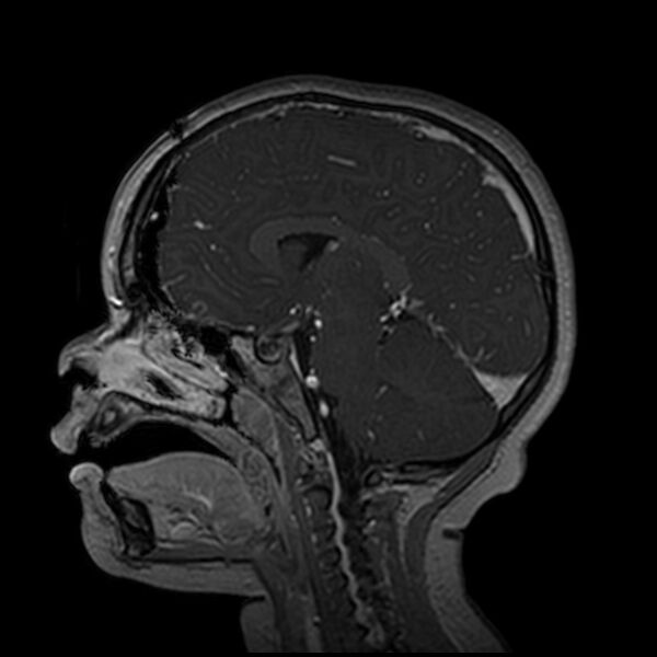 File:Adamantinomatous craniopharyngioma (Radiopaedia 77407-89529 H 56).jpg