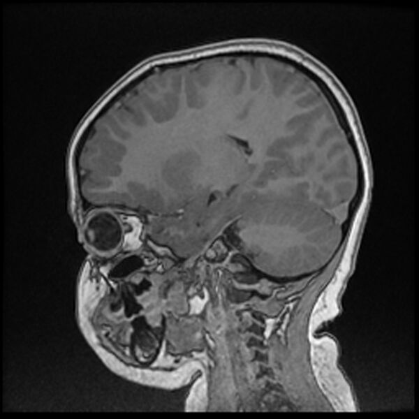 File:Adamantinomatous craniopharyngioma (Radiopaedia 77407-89529 Sagittal T1 C+ 86).jpg