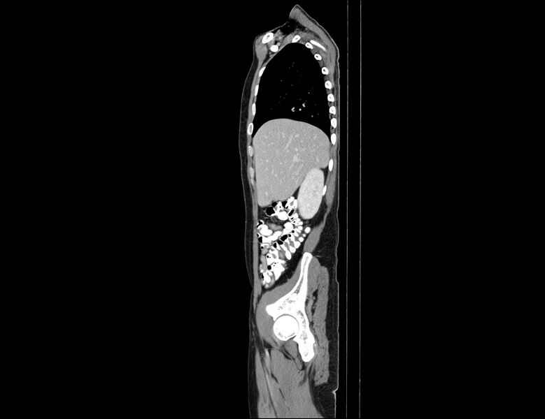 File:Addison disease (Radiopaedia 49318-54412 Sagittal C+ portal venous phase 53).jpg