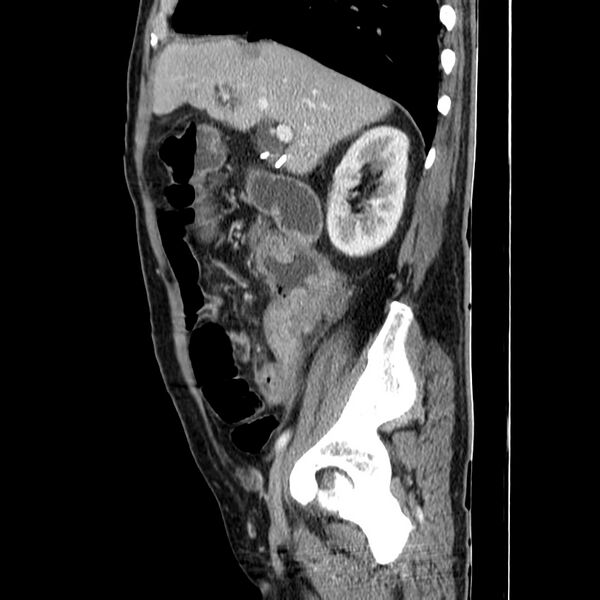 File:Adenocarcinoma of colon with entero-colic fistula (Radiopaedia 22832-22852 Sagittal C+ portal venous phase 21).jpg