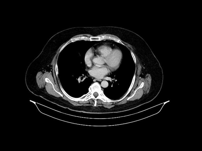 Adenocarcinoma of pancreas with hepatic metastasis (Radiopaedia 64332-73122 Axial C+ delayed 6).jpg