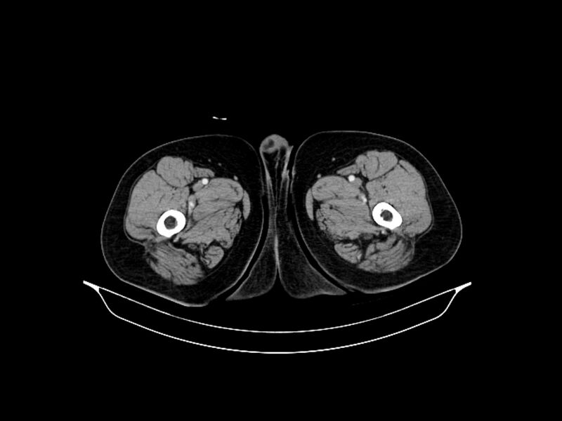 File:Adenocarcinoma of pancreas with hepatic metastasis (Radiopaedia 64332-73122 Axial C+ portal venous phase 117).jpg