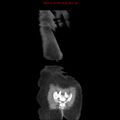 Adenocarcinoma of the colon (Radiopaedia 8191-9039 Coronal liver window 46).jpg