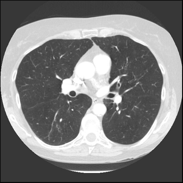 File:Adenocarcinoma of the lung (Radiopaedia 41015-43755 Axial lung window 59).jpg